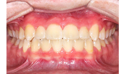 Before & After | Twaddle Orthodontics Columbia, MO