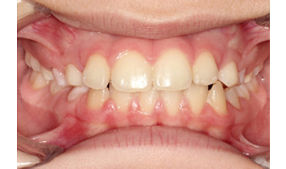 Before & After | Twaddle Orthodontics Columbia, MO