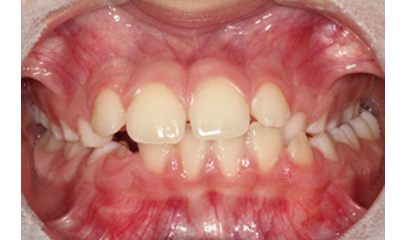 Before & After | Twaddle Orthodontics Columbia, MO